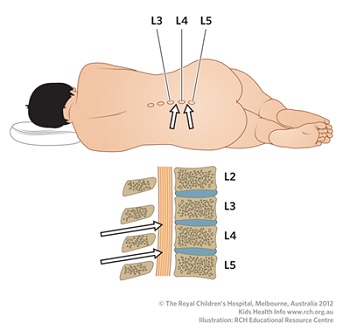 Lumbar puncture